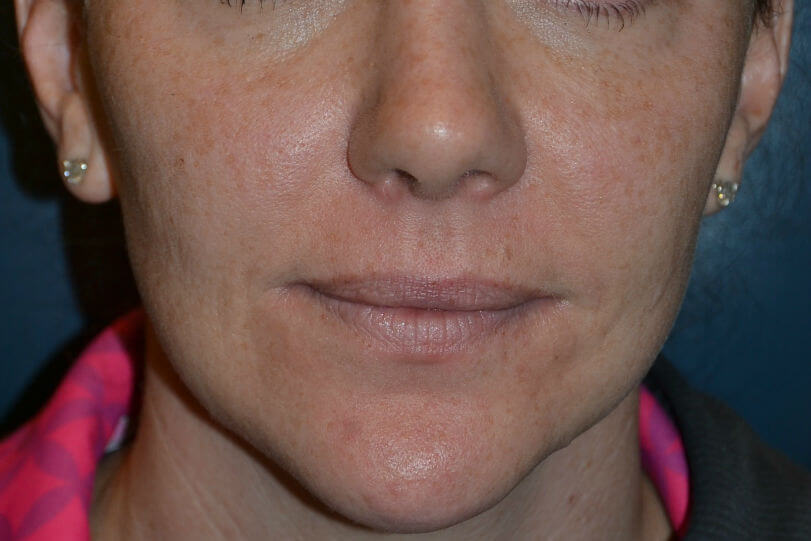after injectable fillers female patient front view case 3110