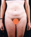 after liposuction front view female patient case 1463