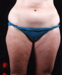 before liposuction front view female patient case 1463