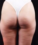 before liposuction back view female patient case 1456