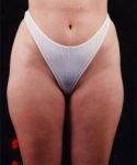 before liposuction front view female patient case 1456