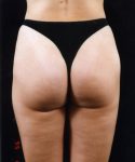 after liposuction back view female patient case 1456