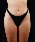 after liposuction front view female patient case 1456