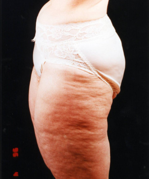 before liposuction left side view male patient case 1449