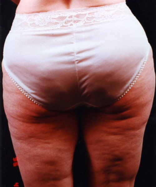 before liposuction back side view male patient case 1449