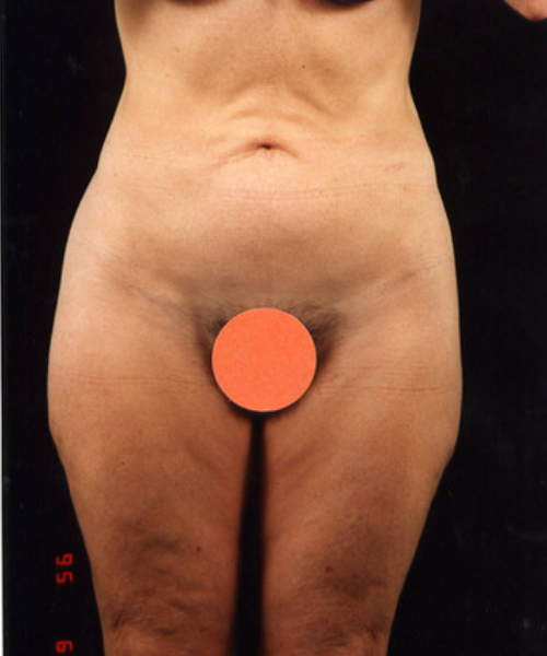 after liposuction front view male patient case 1449