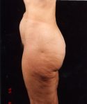 after liposuction left side view male patient case 1449