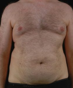 before liposuction front view male patient case 1434