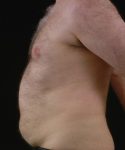 before liposuction side view male patient case 1434