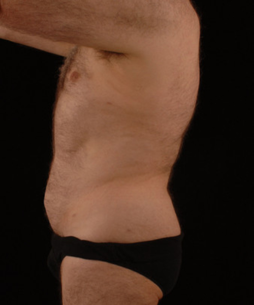 after liposuction side view male patient case 1434