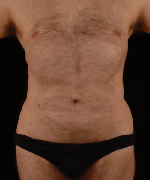 after liposuction front view male patient case 1434