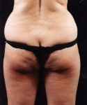 before liposuction back view female patient case 1424