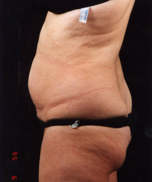 before liposuction left side female patient case 1424