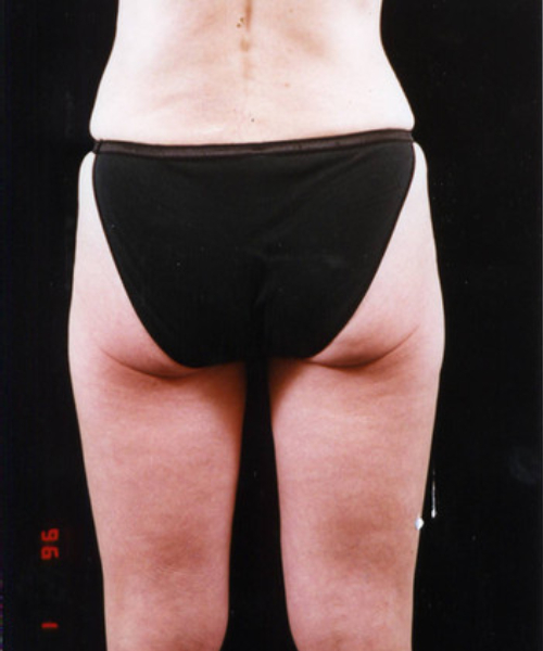 after liposuction back view female patient case 1424
