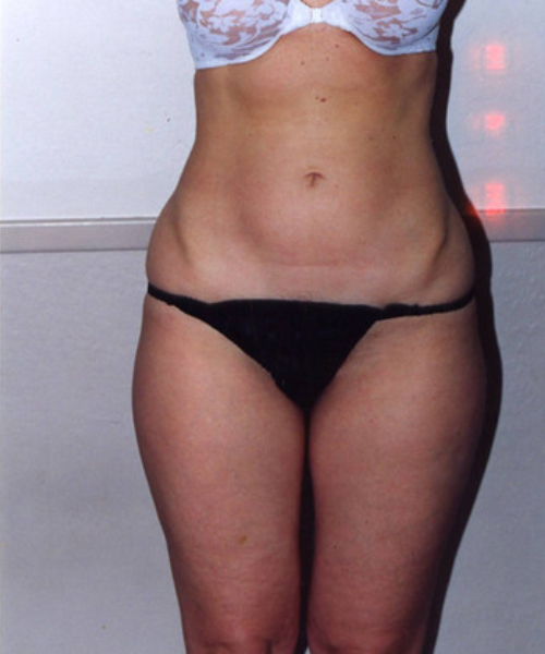 before liposuction front view female patient case 1419