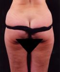 before liposuction back view female patient case 1419