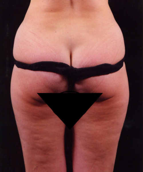 before liposuction back view female patient case 1419