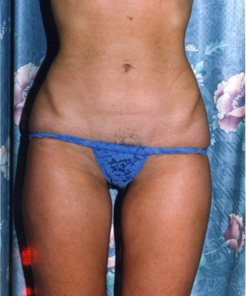 after liposuction front view female patient case 1419