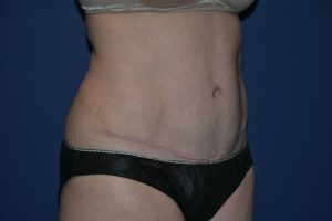 after tummy tuck female patient right angled view case 3216