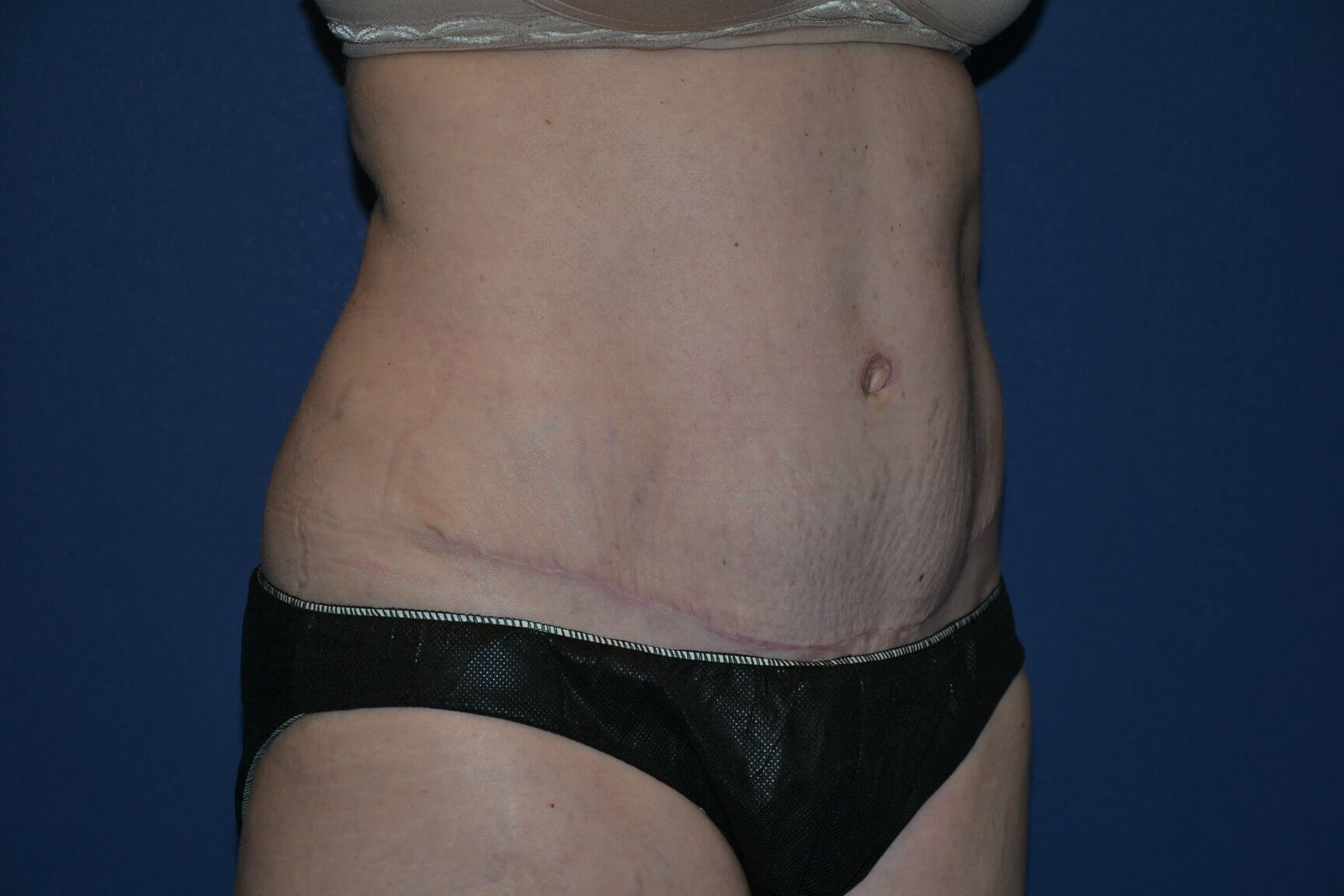 after tummy tuck female patient right angled view case 3216