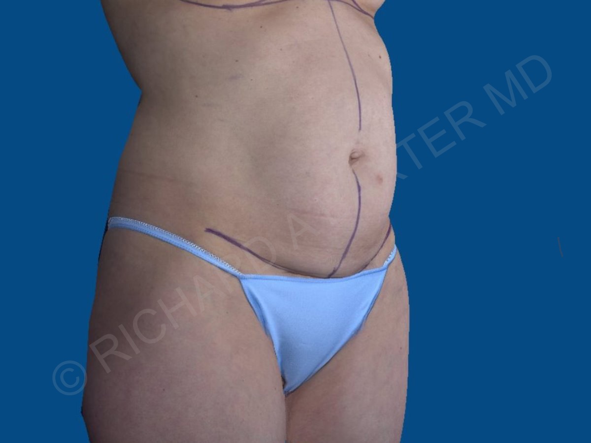 before tummy tuck angle view female patient case 3331
