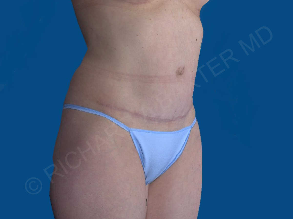 after tummy tuck angle view female patient case 3331
