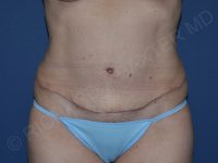 after tummy tuck front view female patient case 3359