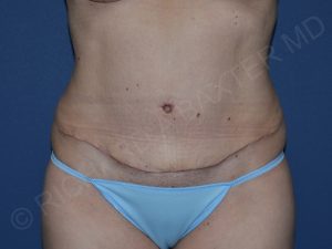 after tummy tuck front view female patient case 3359