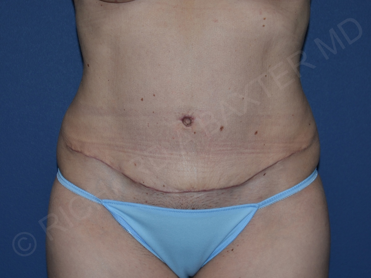 after tummy tuck front view female patient case 3359