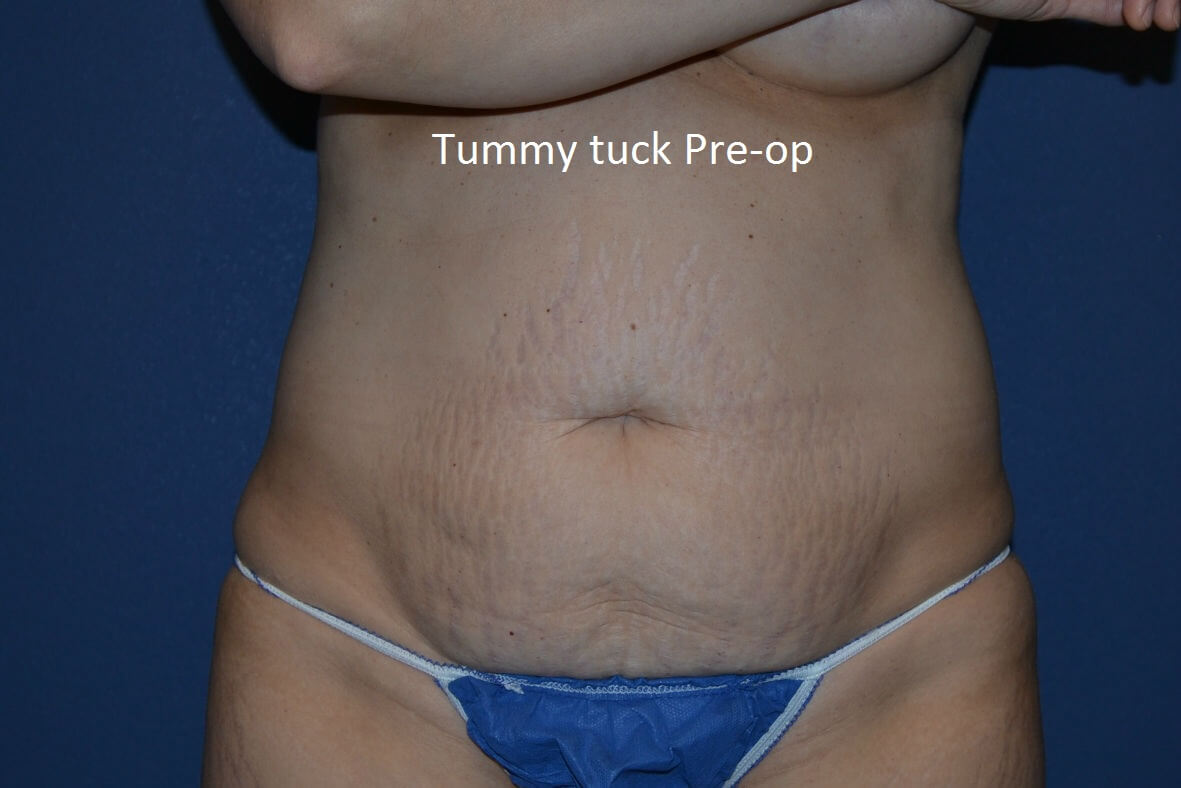 before tummy tuck front view female patient case 3364