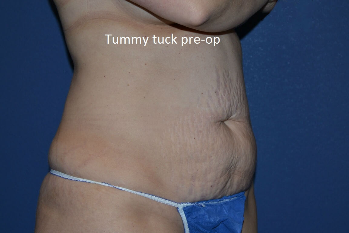before tummy tuck angle view female patient case 3364