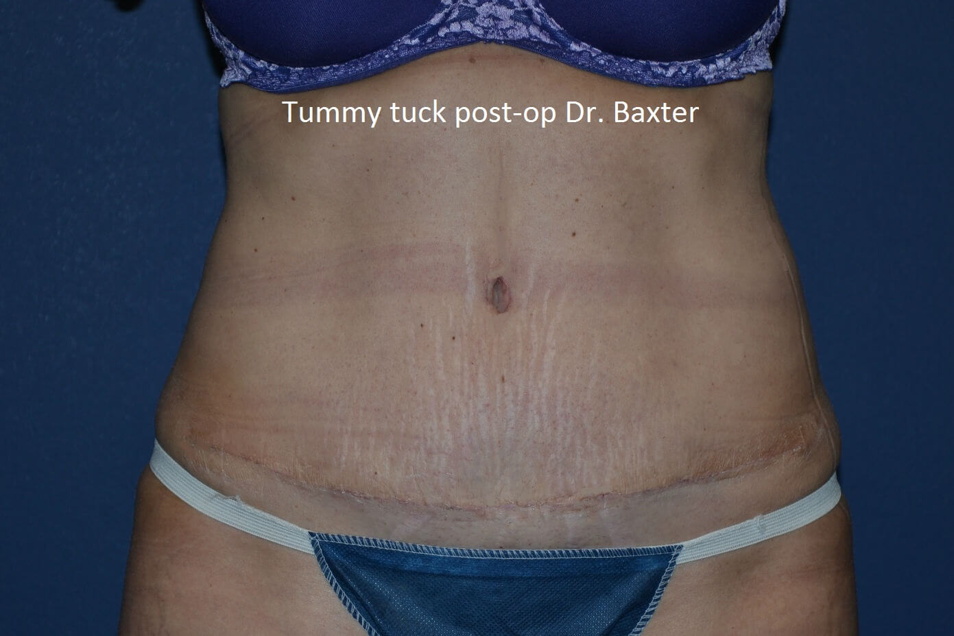 after tummy tuck front view female patient case 3364
