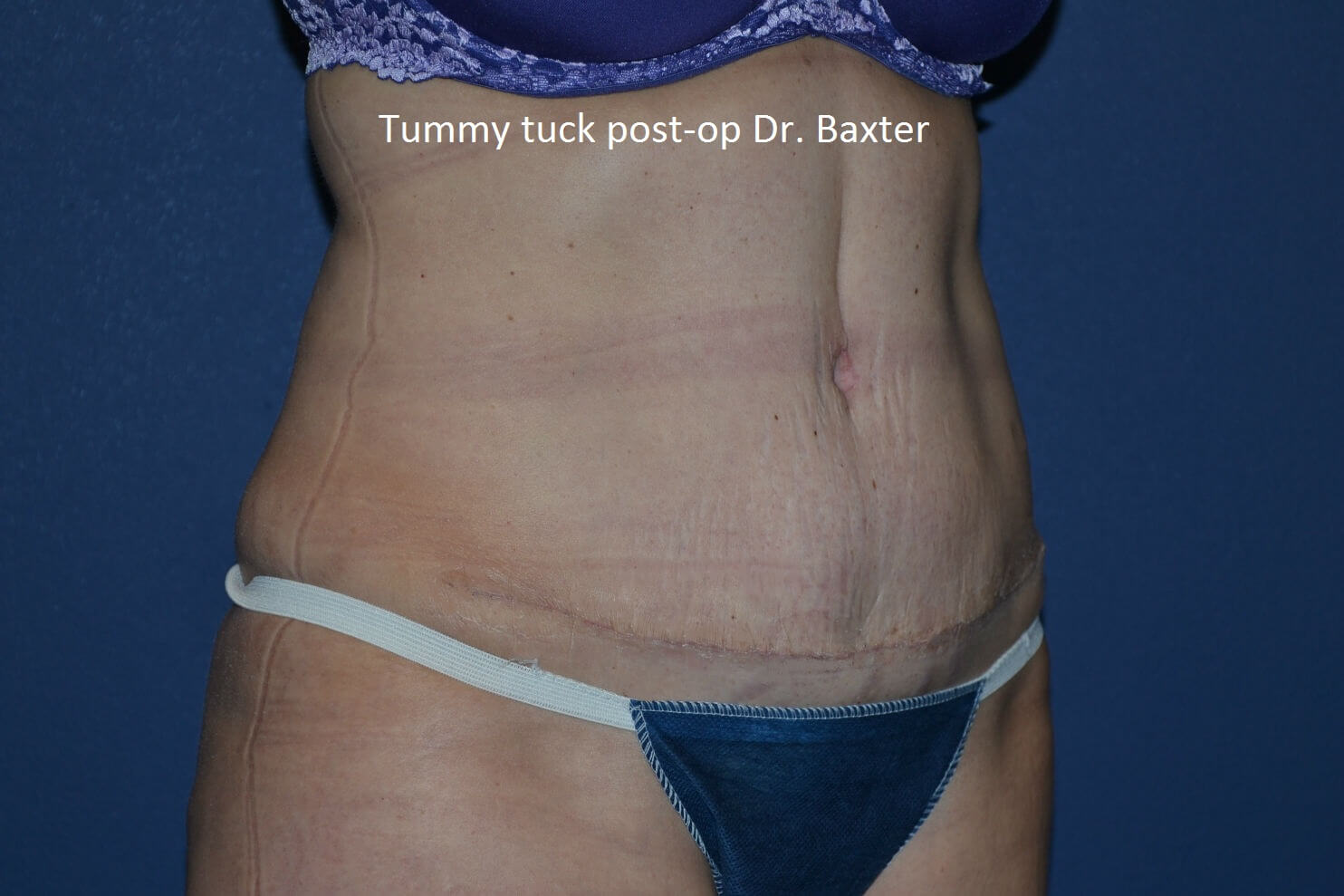 after tummy tuck angle view female patient case 3364