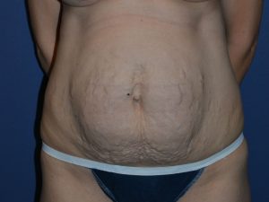 before tummy tuck front view female patient case 3369