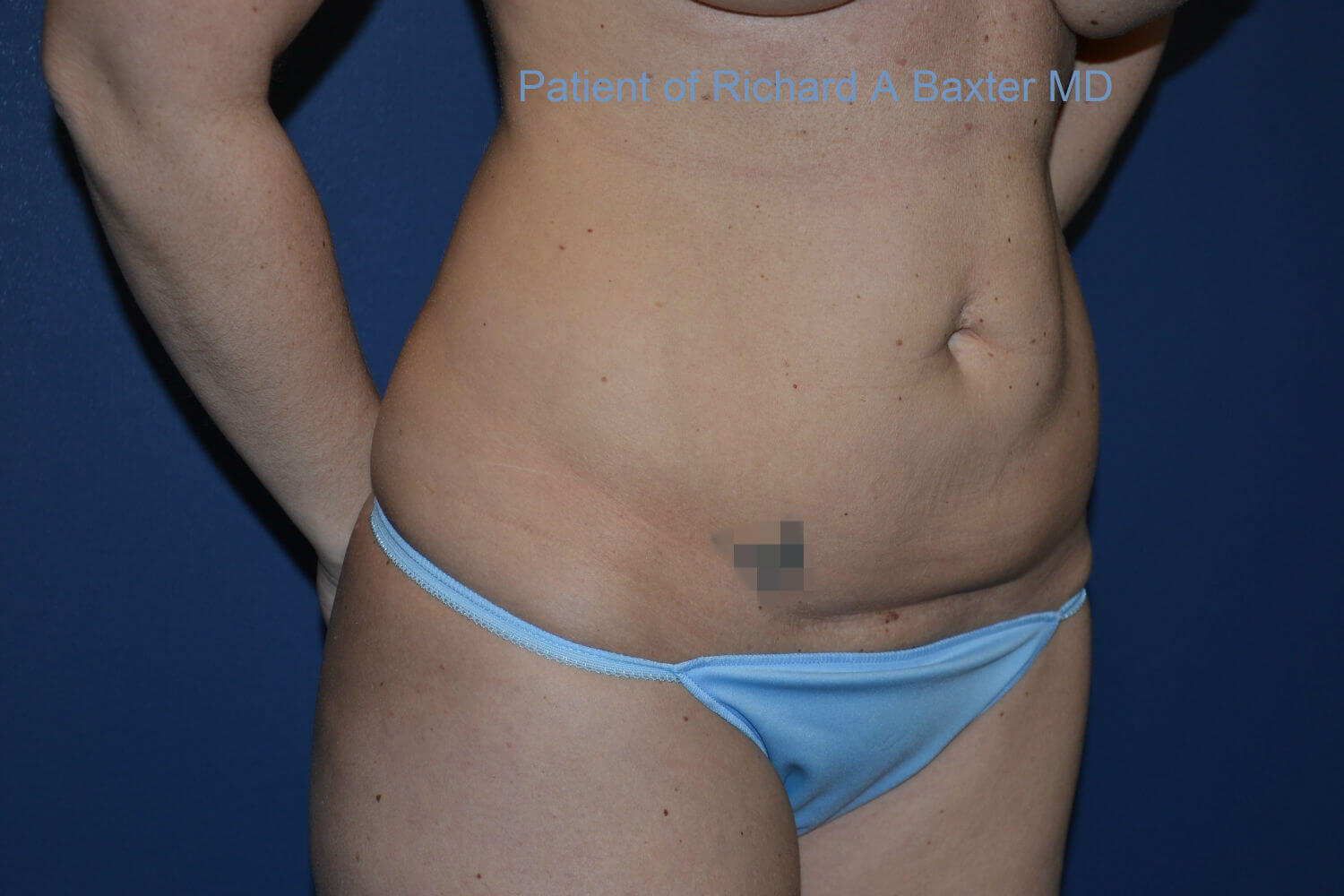 before tummy tuck angle view female patient case 3201