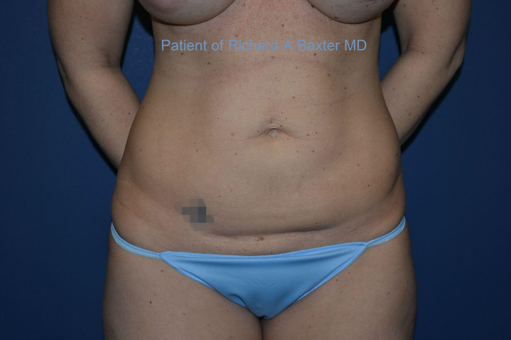 before tummy tuck front view female patient case 3201