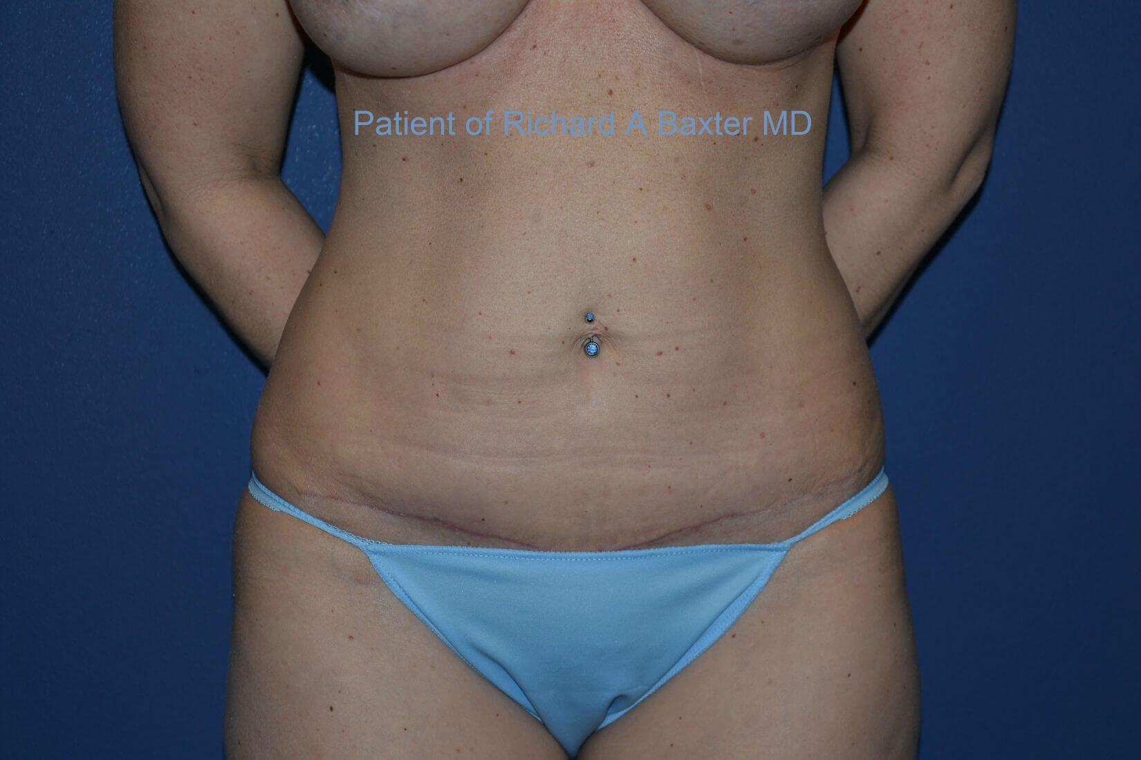 after tummy tuck front view female patient case 3201