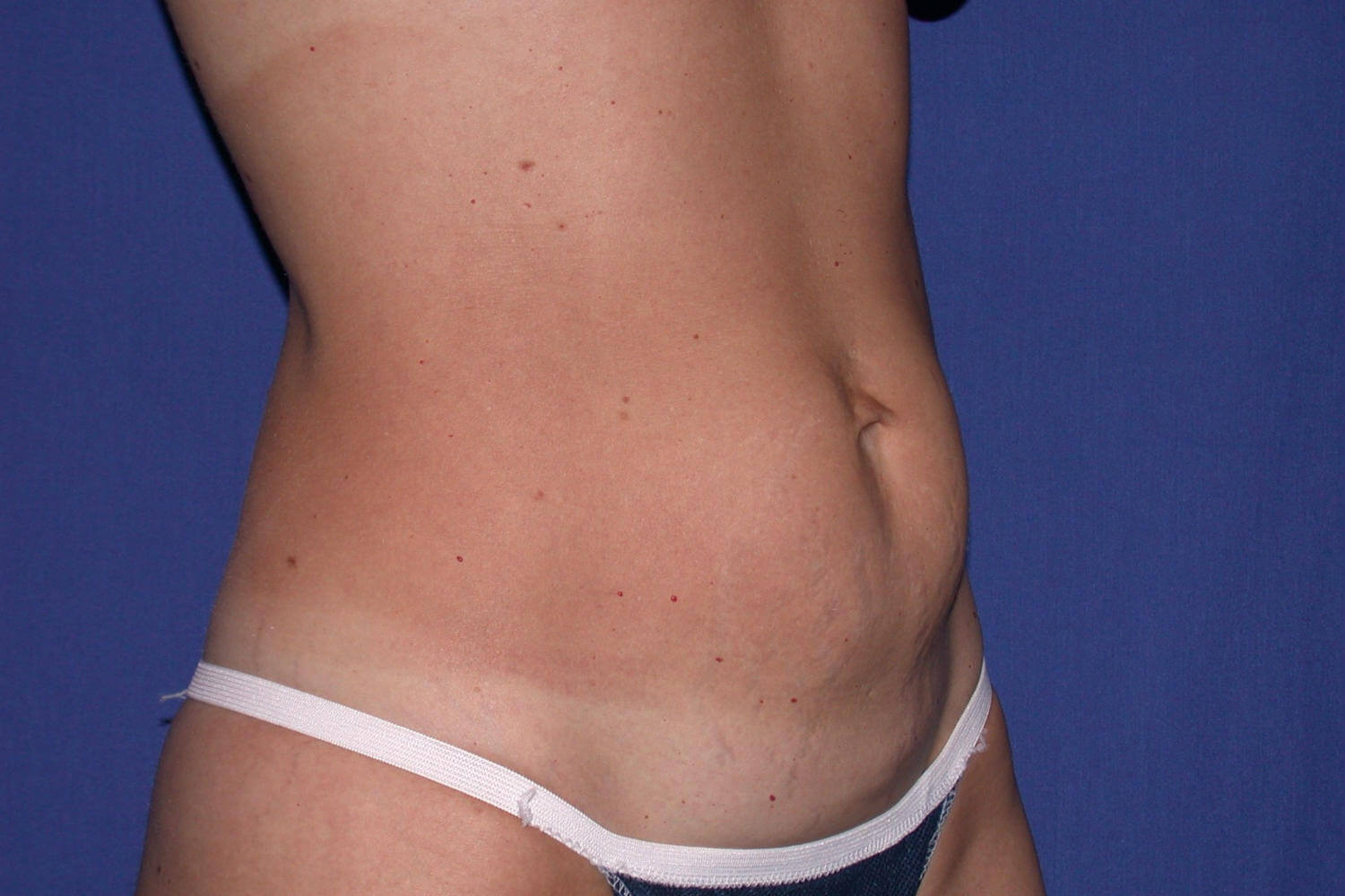 before tummy tuck angle view female patient case 3210