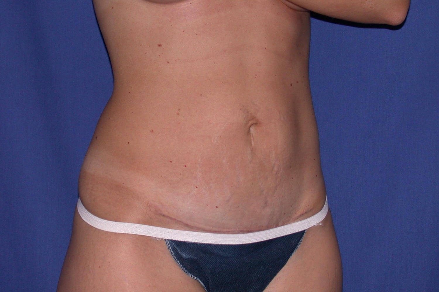 after tummy tuck angle view female patient case 3210