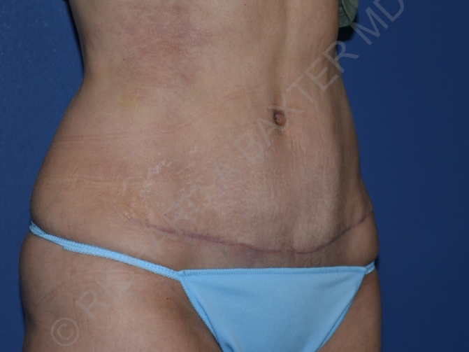 after tummy tuck female patient right angle view case 3340