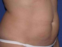 before tummy tuck female patient right angle view case 3196
