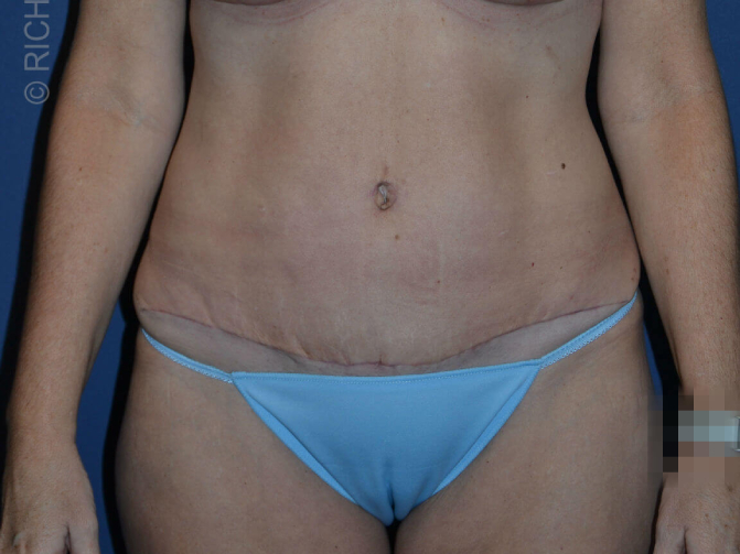 after tummy tuck female patient front view case 3168