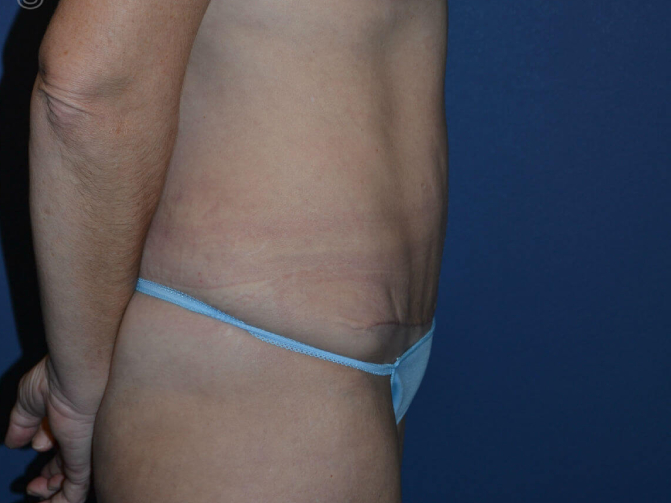after tummy tuck female patient right side view case 3168