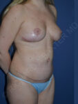 after tummy tuck female patient right angled view case 3131