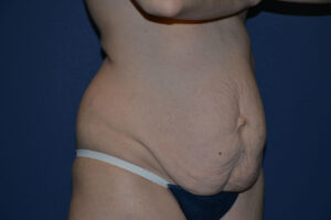 before tummy tuck female patient right angled view case 3216