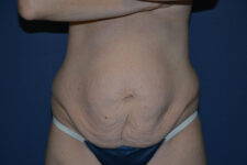 before tummy tuck female patient front view case 3216