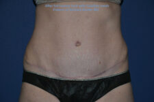 after tummy tuck female patient front view case 3216