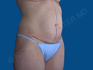 before tummy tuck angle view female patient case 3331