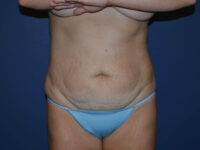 before tummy tuck front view female patient case 3340