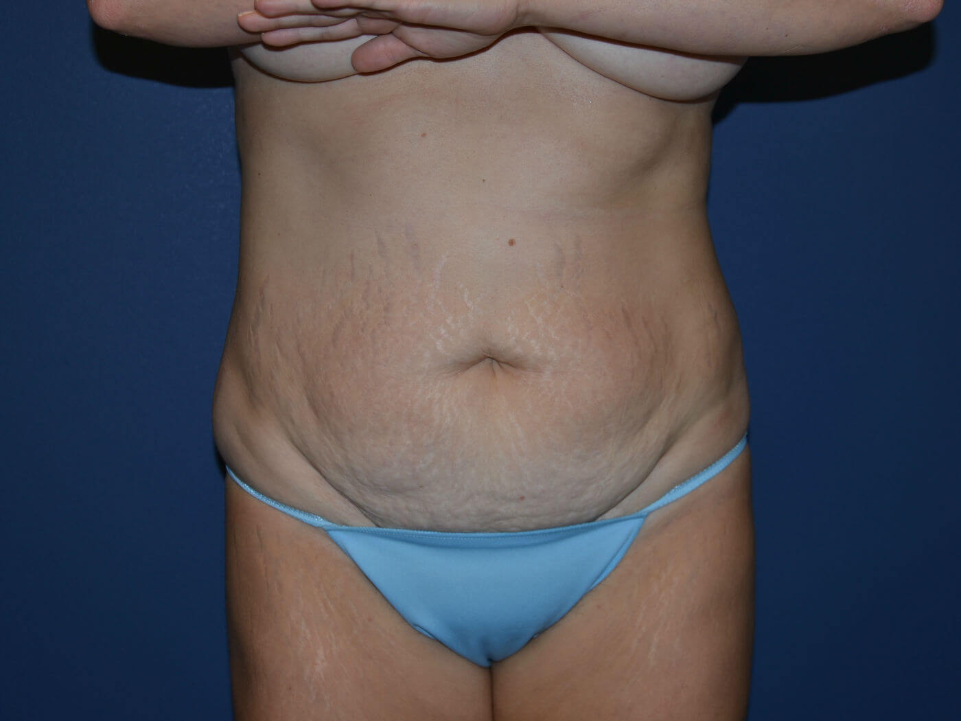 before tummy tuck front view female patient case 3340
